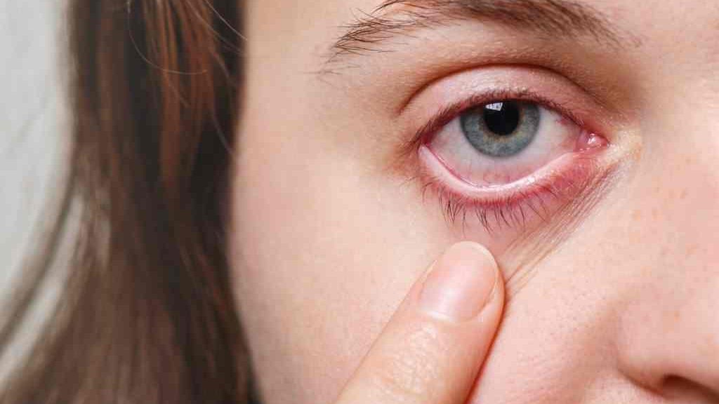 Dry Eye Syndrome Treatment
