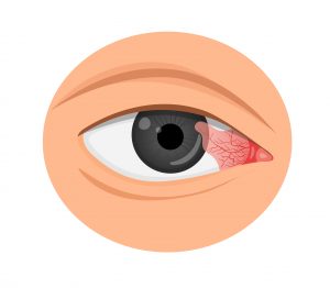 most-common-eye-infection