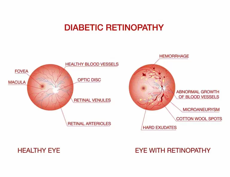 normal-eye-vs-diabetic-eye