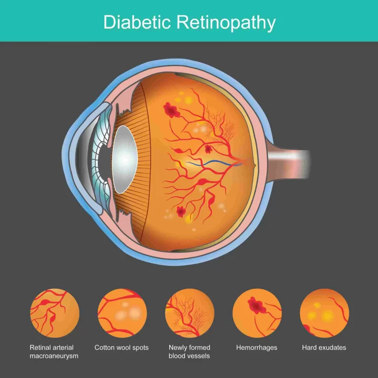 structure-of-diabetic-eye