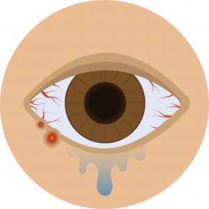 dry-eyes-treatment-in-gurgaon